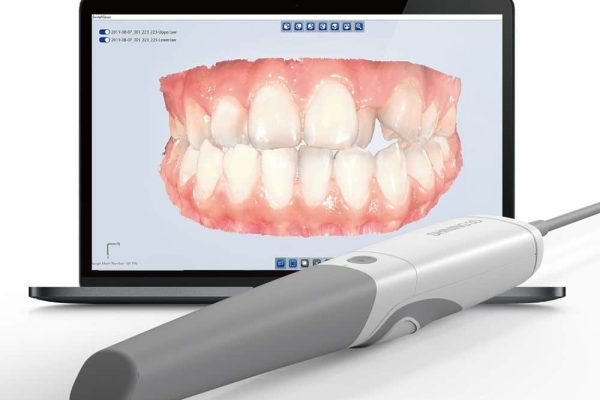 3D-Dental-Imaging-Intraoral-Scanning-Mint-Mini-Dental-Implants