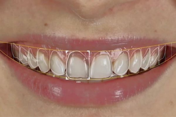 Explore-advanced-Digital-Smile-Design-technology