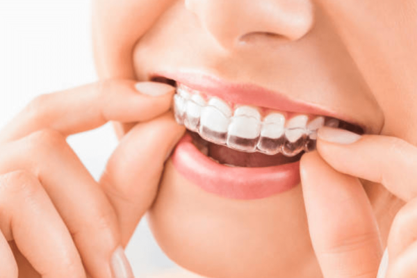 How-Clear-Aligners-Work