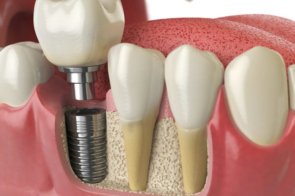 tooth_dental_implant